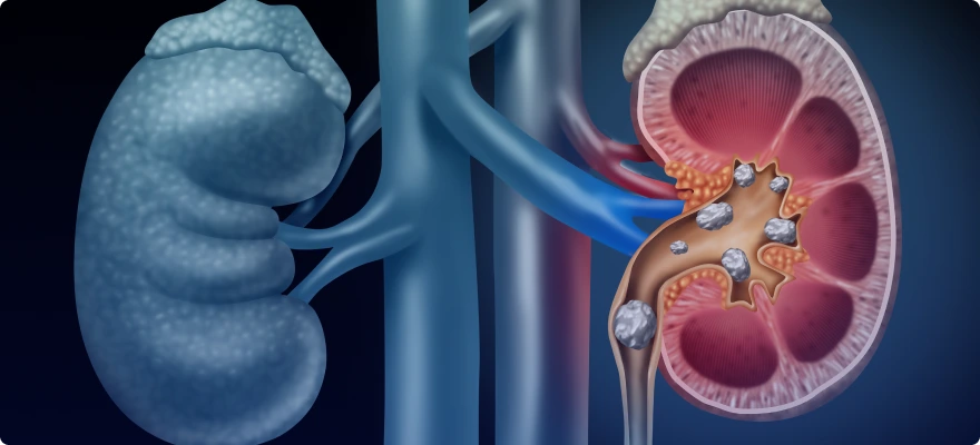 ABCD of Kidney Stones